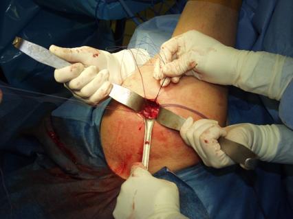 Mini-open rotator cuff repair performed C-Arm used to locate needle tip