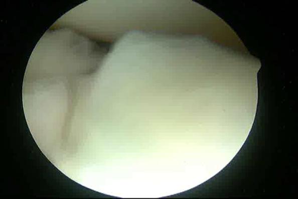 Arthroscope anterior, debridement