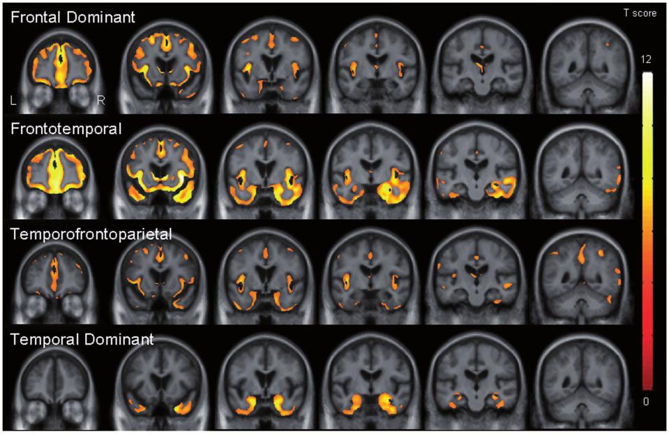 Anatomical variants of bvftd Brain 2009: 132; 2932 2946 2939 Figure 3 Coronal slices through the template showing patterns of grey matter loss in each of the four subtypes compared to controls
