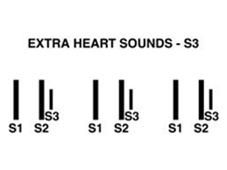 Extra sounds S3 ventricular gallop sounds like lub dub ta Occurs at the beginning of diastole after S2 Usually benign in youth, athletes, and sometimes in pregnancy Note location, timing, intensity,