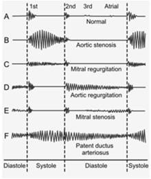 Extra sounds Murmurs Timing: systole or diastole Location where the murmur is loudest Grade the intensity 1 6 Pitch: high, medium, or low Quality: blowing, harsh, rumbling, or musical Slide 34 Grade