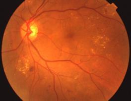 Screening and prevention of microvascular complications Diabetic retinopathy Diabetic nephropathy Diabetic neuropathy Foot care