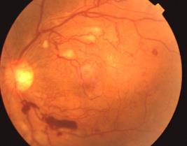 Proliferative DR Macular edema NPDR was characterized by an increase in vascular permeability or vascular closure Such as :