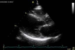 valvular, congenital, MI, cardiomyopathy Size