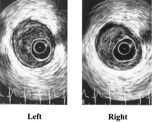(B,C,D) Intravascular ultrasound images at the same lesion as A demonstrating compensatory enlargement.