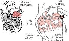 Tabular List OPERATIONS ON THE CARDIOVASCULAR SYSTEM 37.67 37.79 3 ' Additional Digit Required 37.