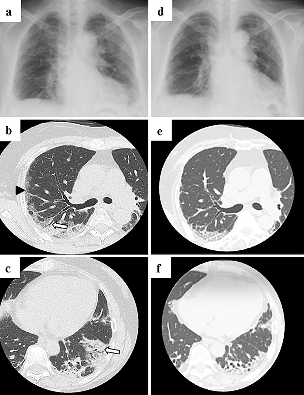 Figure 1. Pulmonary manifestations at the initial diagnosis (a, b, and c) and on the 106th day of hospitalization (d, e, and f).