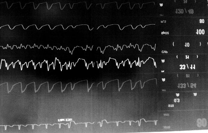 However, the QT interval gradually shortened, and further episodes of ventricular arrhythmia did not occur.