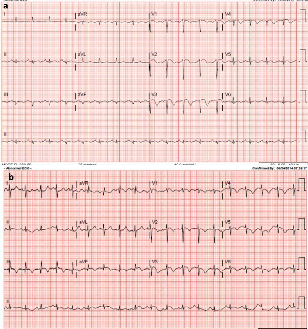 Figure 1: 12-lead electrocardiograms of 2 patients who die in-hospital from acute pulmonary embolism showing ST-segment