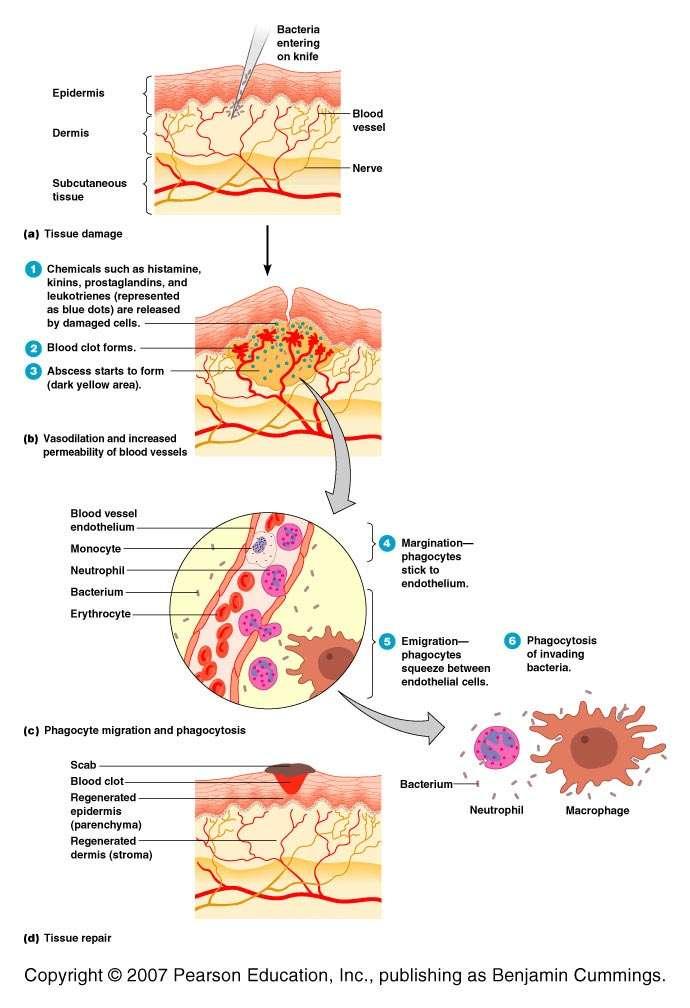 E. Inflammation Bodily response to cell damage characterized by redness, pain, heat, and swelling. 1.