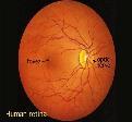 retinoathy which is caused by athological changes of the blood vessels which nourish the retina.