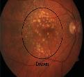 AMD is characterized by drusen, retinal igmentation, and atrohy of hotorecetors. It has several risk factors. They are, age, smoking, hyertension and family history.