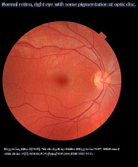 The macula and the fovea Macula Superior Nasal Superior Temporal Fovea Inferior Nasal Inferior Temporal The macula is located lateral to the optic disc (about 1 1 / 2 disc diameters of light away)