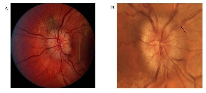 Culturally based variability in the colour of the iris and in retinal pigmentation darker irises correlate with darker retinas.