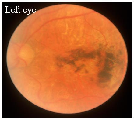 In the image below image A shows a grade II papilledema with a diffuse halo effect around the optic disc, image B shows a grade III papilledema showing loss of major vessels as they leave the disc