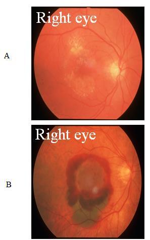 Wet macular degeneration is characterised by blood vessels that grow under the retina (arising from the choroid, a choridal neovascular membrane) in the back of the eye, leaking blood and fluid.