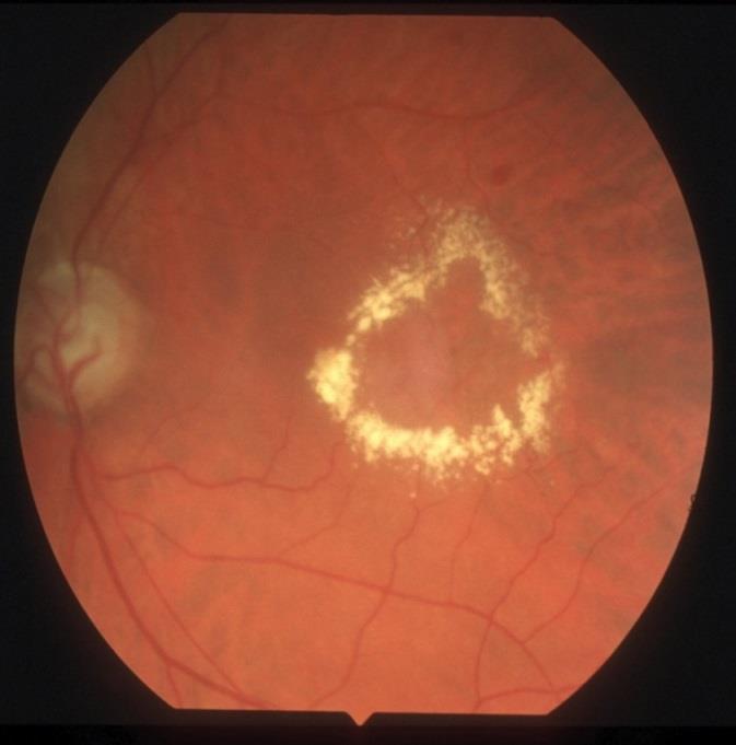 The image on the left is of a patient with diabetic retinopathy. Non-proliferative retinopathy is where blood vessels in the retina deteriorate.