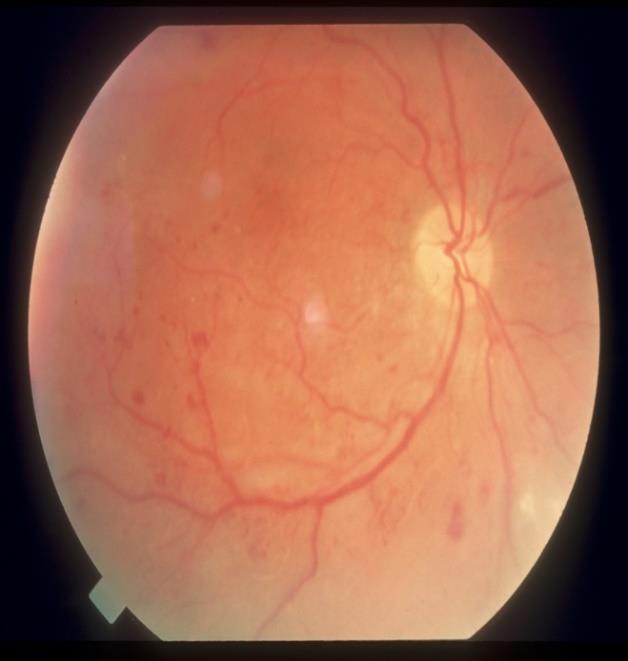 Fluid can collect in the retina and the swelling may impair sharp vision, especially when it affects the macula.