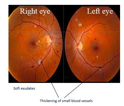 They can cause frequent minor bleeding causing floaters which may be visualised and also may cause the separation of the layers of the retina (fractional retinal detachment).