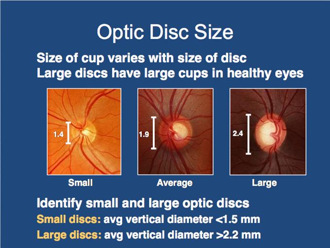 in the optic disc only 1 Both (10%) Disc change only (55%) Field change only (35%) OHTS converters 1. Kass et al.