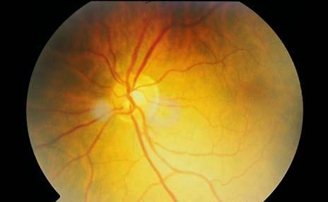 APON Increase C/D Ophthalmoscopic