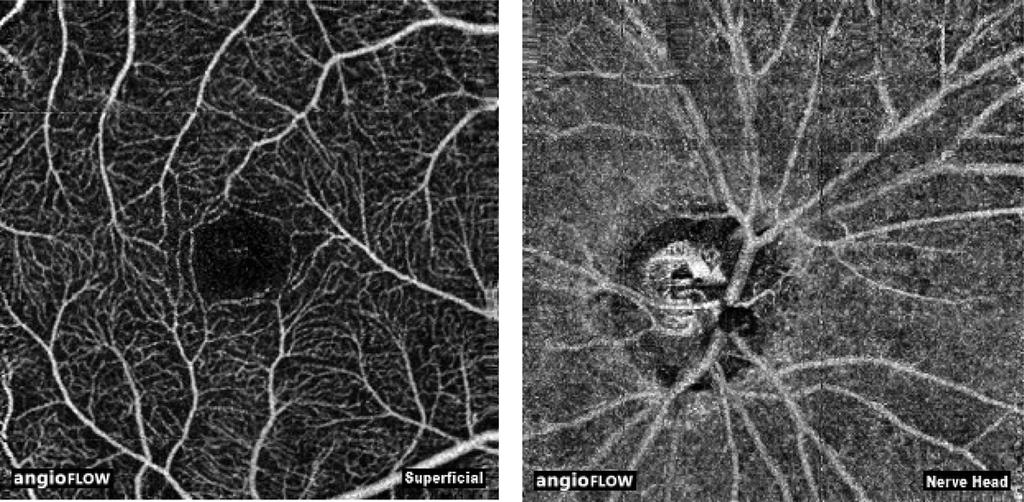 Lim et al. BMC Ophthalmology (2018) 18:315 Page 3 of 10 scans. The optic nerve head scan was a 3 x3mm cube centered on the optic nerve head. The macular scan was a 3 3 mm cube centred on the fovea.