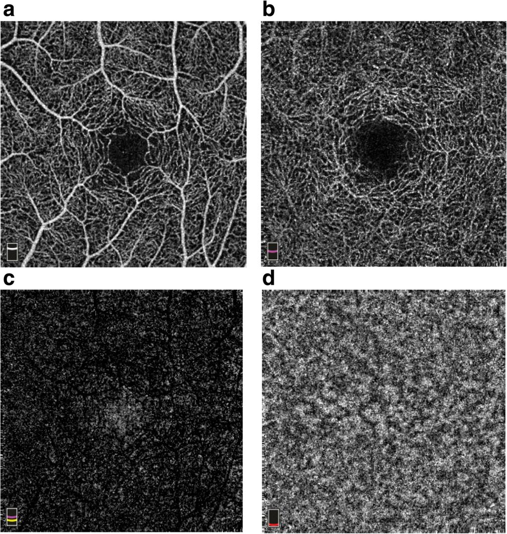 Lim et al. BMC Ophthalmology (2018) 18:315 Page 5 of 10 Fig. 2 Macular image segmentation. a Superficial retina capillary plexus. b Deep retina capillary plexus. c Outer retina capillary plexus.