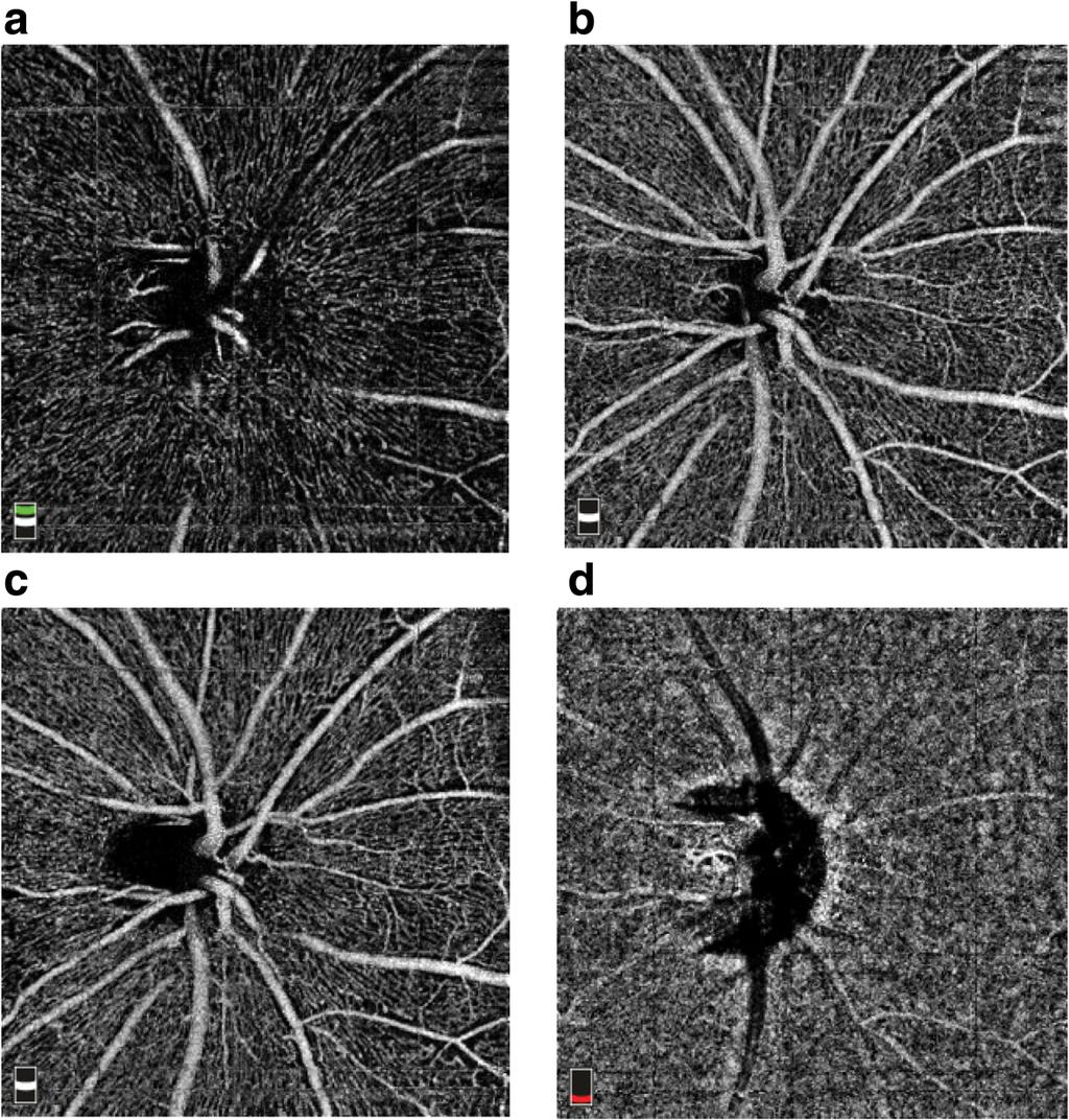 Lim et al. BMC Ophthalmology (2018) 18:315 Page 6 of 10 Fig. 3 Optic disc image segmentation. a Vitreoretinal interface. b Superfical Optic nerve head. c Radial peripapillary capillaries.
