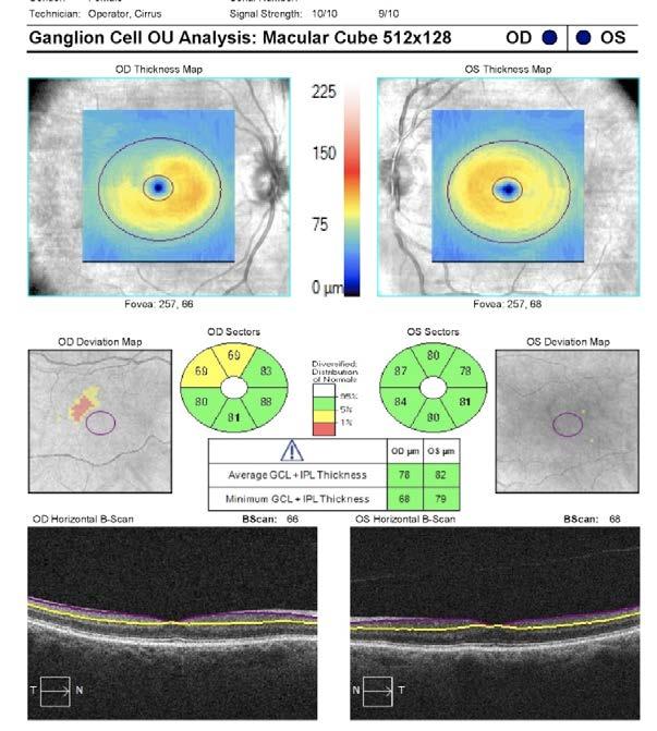 analysis Optical coherence tomography (OCT) of the RNFL and GCL are shown
