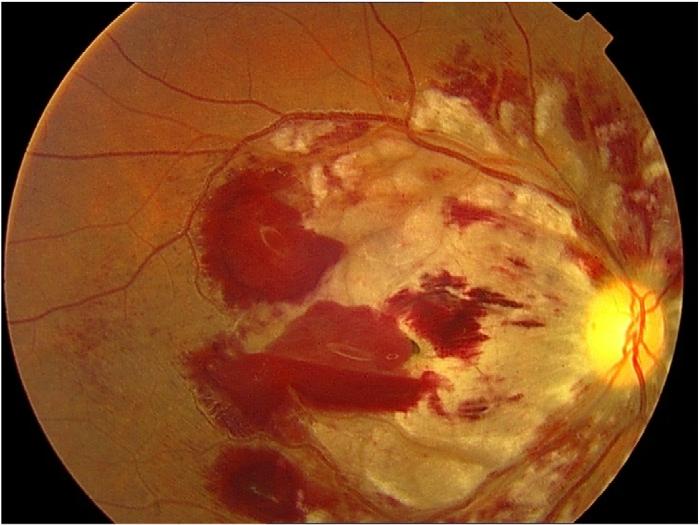 Page 3 of 5 Figure 2. Right eye fundus photograph, another view. Figure 3.