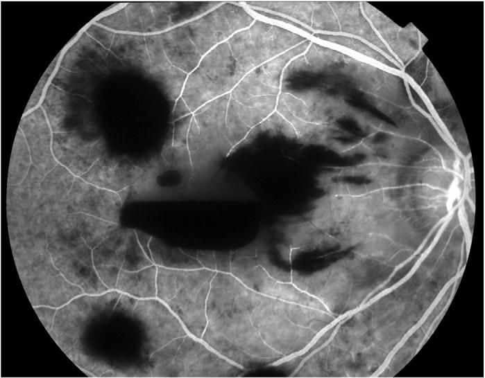 Fundus Fluorescein Angiogram (FFA) was done three weeks after the injury as the patient was prescribed strict bed rest by the orthopedic surgeon.