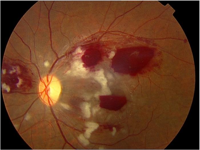 Page 4 of 5 Figure 4. Left eye fundus photograph shows a milder picture, with no involvement of the optic disc. Figure 5. Left FFA shows blocked fluorescence and capillary dropout.