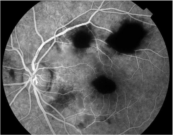 Our patient suffered severe chest compression from the vehicle wheel which initiated a cascade of events resulting in the occlusion of pre-capillary arterioles of the retina and the development of
