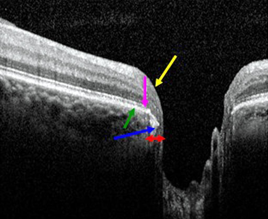 () Peripapillary atrophy (PP) was well-visualized by Spectralis optical coherence tomography (OCT) scanning laser ophthalmoscope imaging.