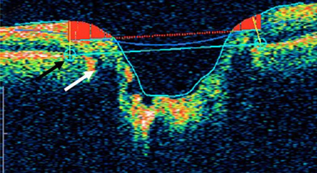 arrow). (green arrow) were easily seen in the β-zone of the OCT PP images. The RL was intact around the optic disc margin and showed hyper-reflectance.