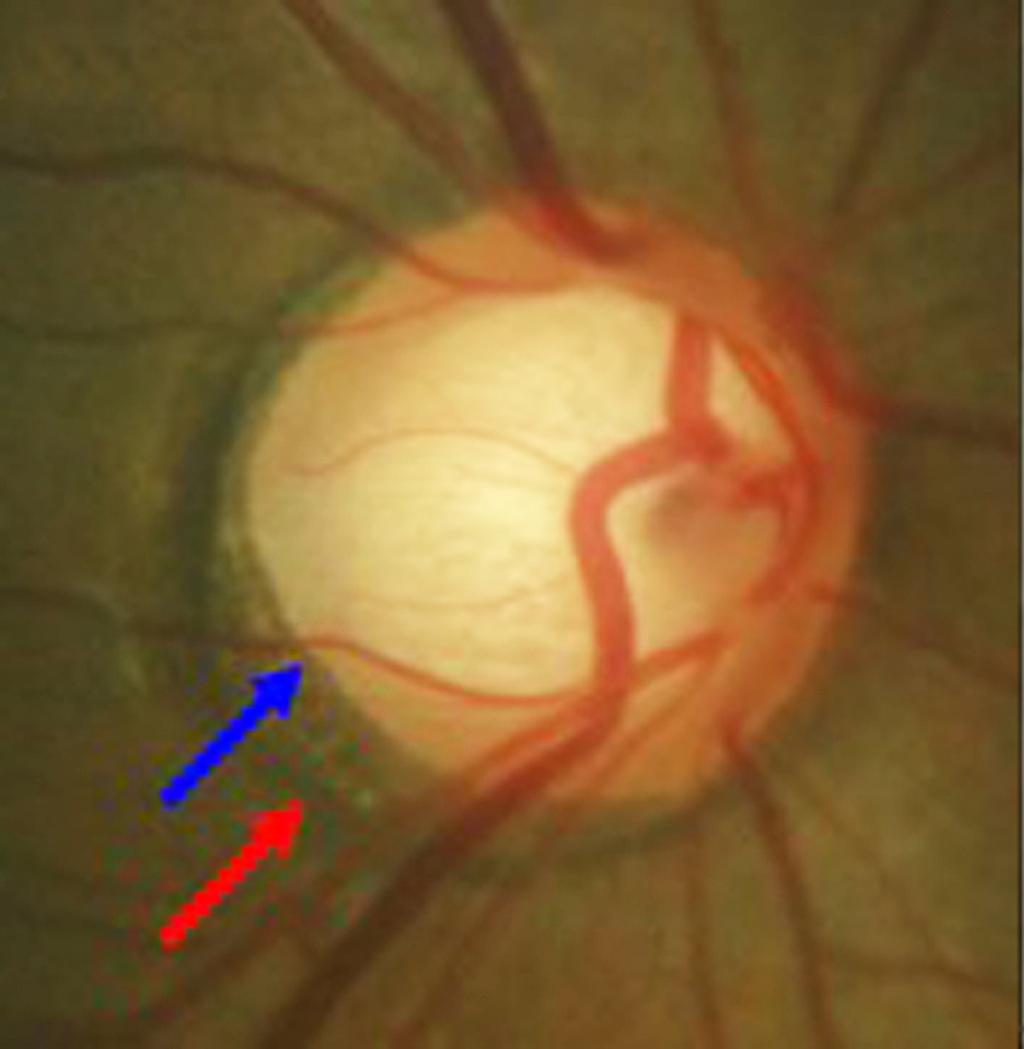 Korean J Ophthalmol Vol.24, No.6, 2010 Fig. 4. () Showed the extent of the β-zone (red arrow) and optic disc margin (blue arrow) on the temporal side of a glaucomatous optic disc.