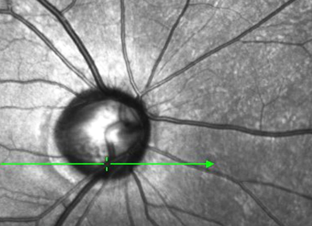 In a cross-sectional image of the optic disc obtained by Spectralis OCT, the RNFL was thinner when the scan line passed through the RNFL bundle defect area (green scan line in ), but RNFL (yellow