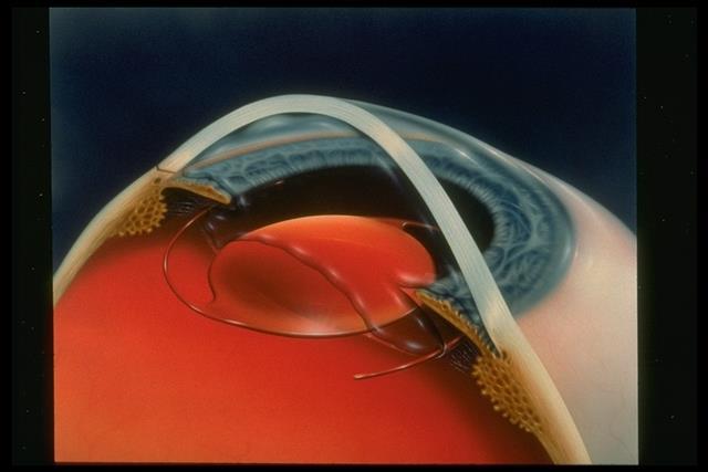 The cornea, the lens and the iris Abnormality Cornea: Ulceration Scarring Anterior chamber: Acute (angle closed) glaucoma Lens: Cataract