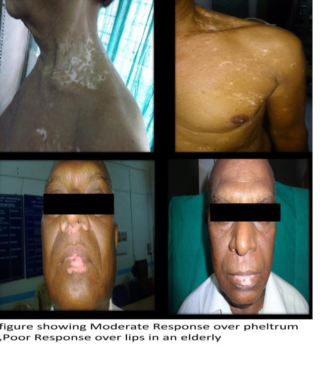 V.Discussion Although PUVA therapy is a well-established first-line treatment for vitiligo, recent studies have shown that NBUVB therapy is more effective,with minimal or no side effects and superior