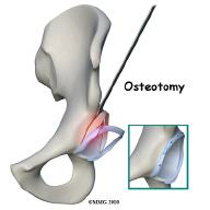 Surgery Surgery is advised when there is persistent pain despite a good effort at conservative care and when there are obvious structural abnormalities of the hip.