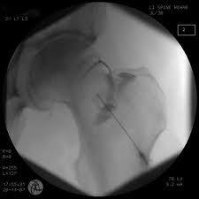 Femoroacetabular impingement (FAI) - Important diagnostic tool: Intra-articular injection of a local-anesthetic,