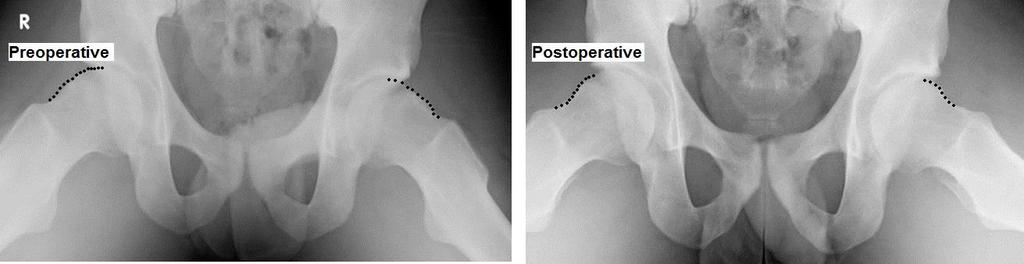 Case example: Bilateral FAI in a young soccer player Bilateral arthroscopic hip surgery (separate
