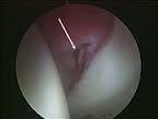 Internal snapping hip (iliopsoas snapping) - Treatment options: 3.