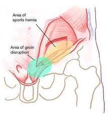 Aponeurosis syndrome Also termed: 1. Sportsman s hernia. 2. Gilmor s hernia. 3.