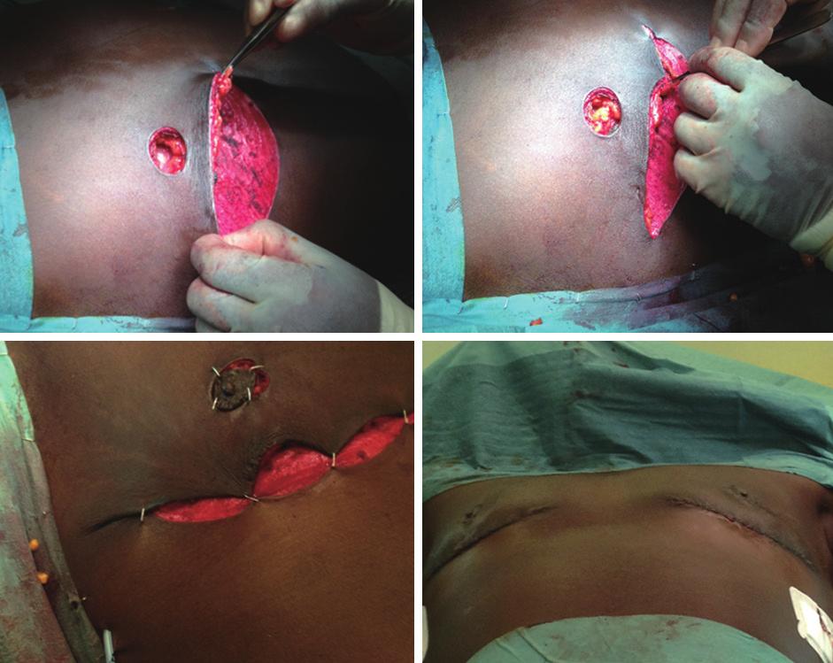 4 Kazzazi and Malata. Lalonde reduction for gynaecomastia in dark skinned patients Figure 3 Intra-operative images of nipple transposition and inframammary incision used in Lalonde technique.