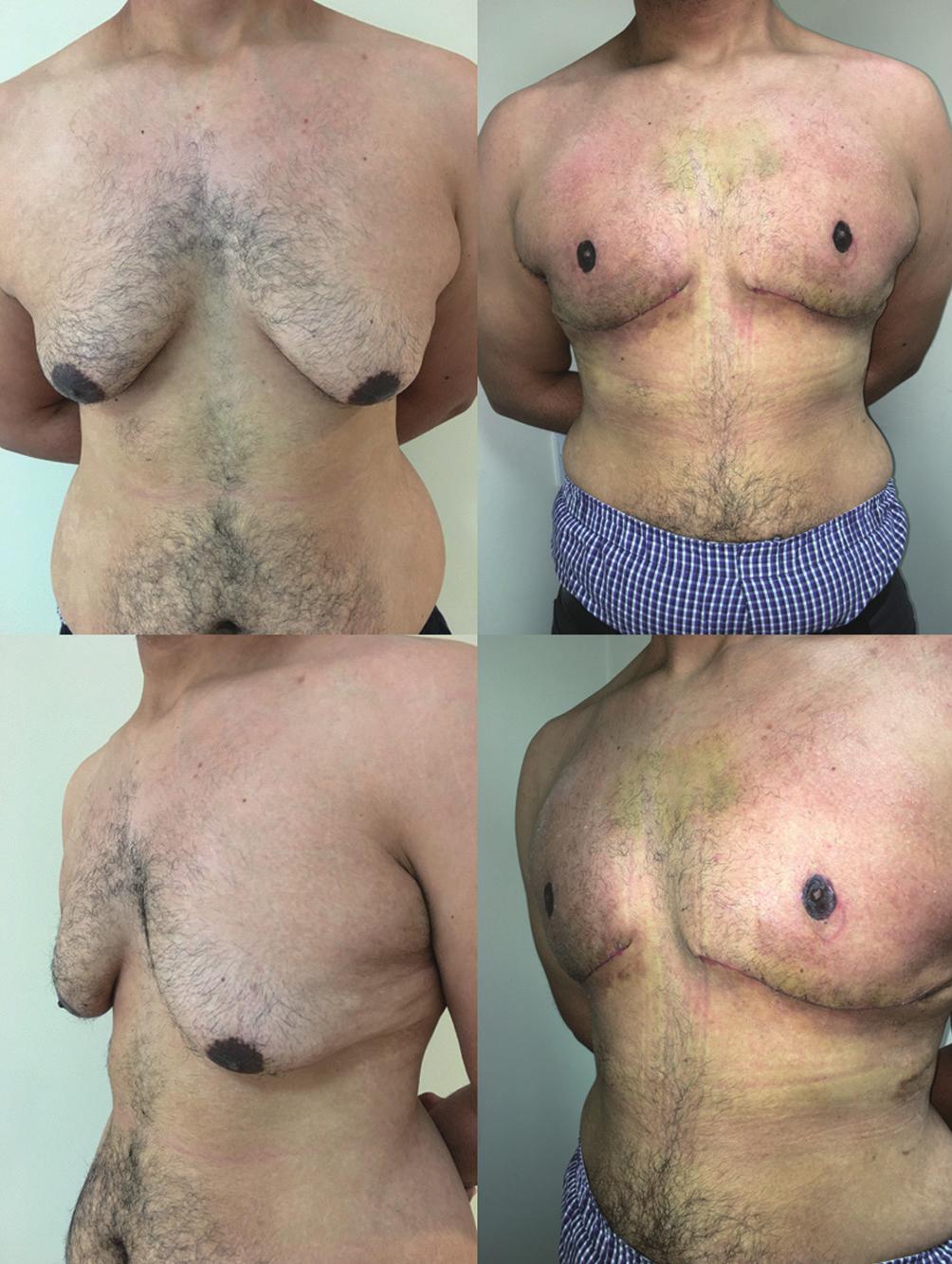 He underwent correction of bilateral gynaecomastia entailing liposuction, open glandular excision and nipple transposition using the Lalonde technique, shown preoperatively (left) and postoperatively