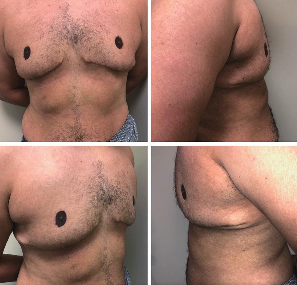 6 Kazzazi and Malata. Lalonde reduction for gynaecomastia in dark skinned patients ends.