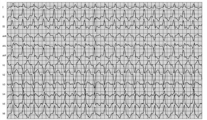 Four types of ventricular tachycardia were induced.