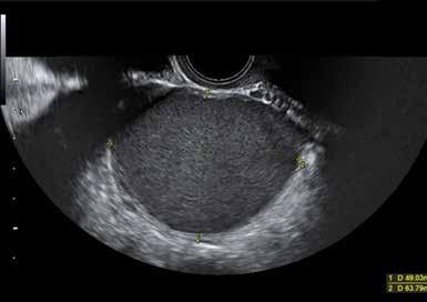 IMAGING IN ENDOMETRIOSIS FIGURE 2. Endometriotic ovarian cysts (endometriomas) (arrow) on transvaginal ultrasonography. FIGURE 3.