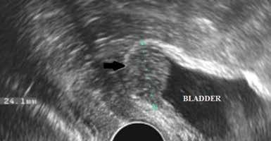 Thus, transabdominal ultrasonography of the kidneys is always recommended when deeply infiltrating endometriosis is suspected.